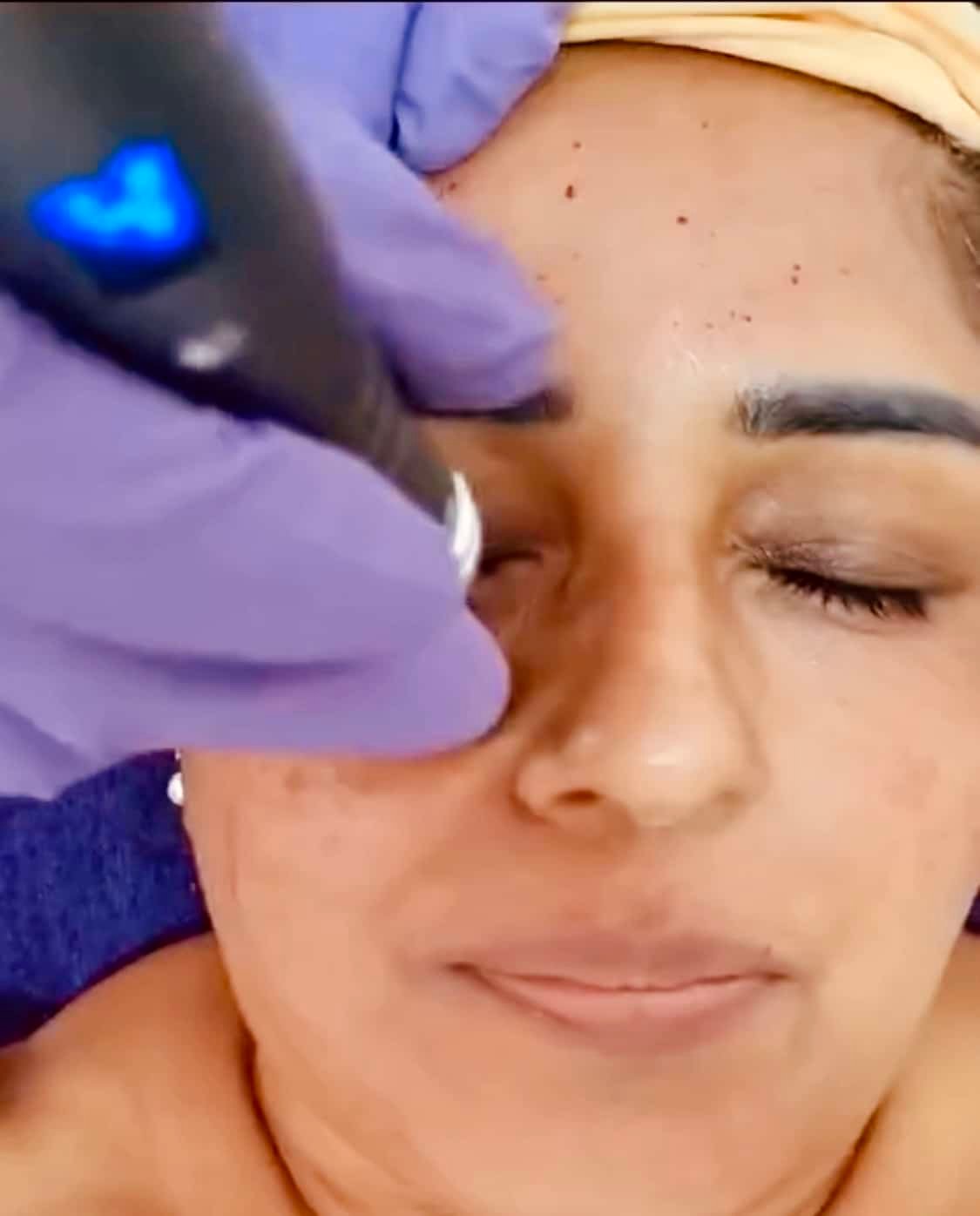 Collagen induction treatment in progress