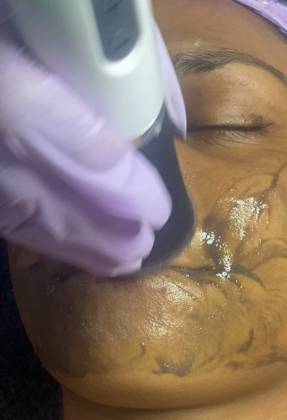 Oxygeneo upgrade — 3 weeks after Hydrafacial