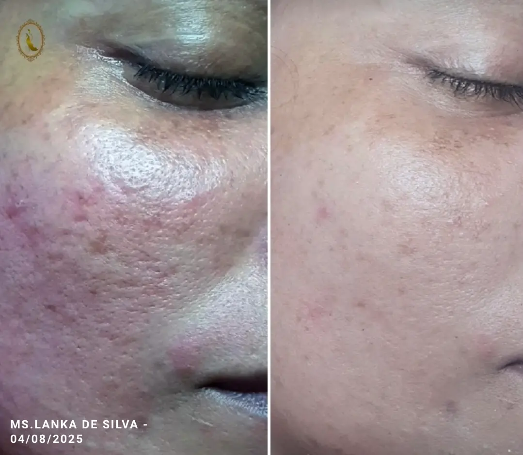 Visible unfiltered results of our Hydrafacial Glow Session