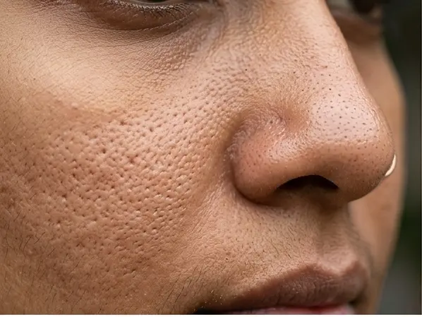 Enlarged pores