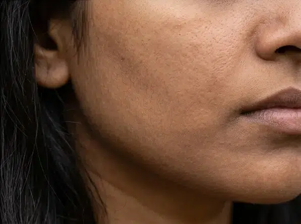 Dull skin